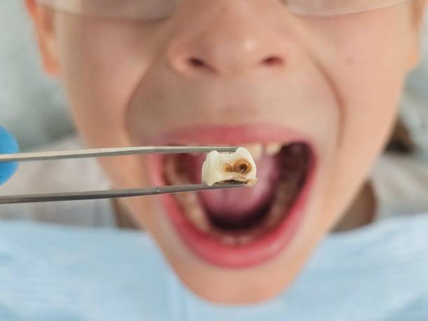 Best Emergency Wisdom Teeth Removal in East Sparta, OH